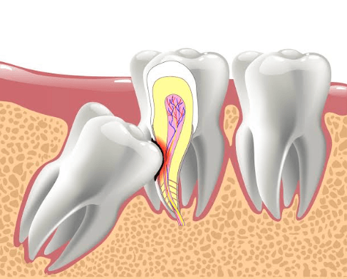 Wisdom Teeth Removal