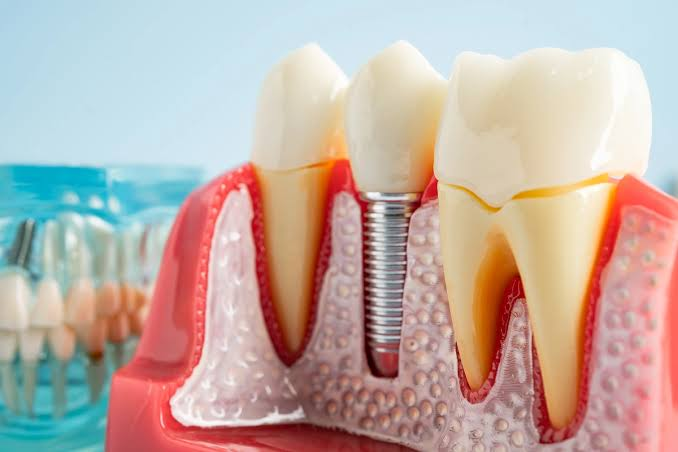 Tooth Replacement Treatments 